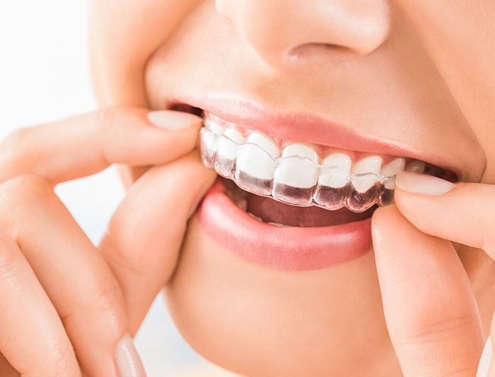 Niềng Răng Trong Suốt Invisalign Có Hiệu Quả Không?