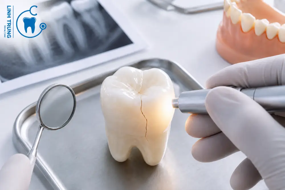 Điều trị răng nứt tại Thủ Đức tại Nha khoa Linh Trung